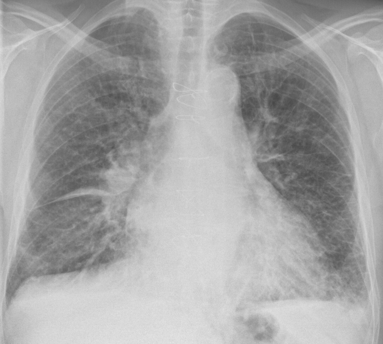 A chest X-ray radiograph showing the lungs and ribcage